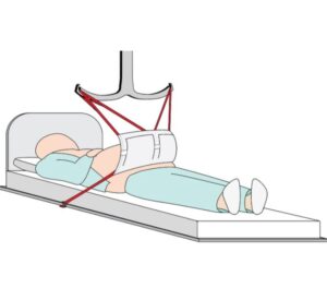 Pannus Apron Sling